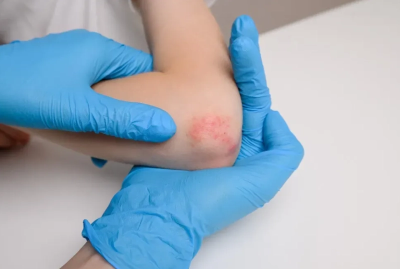 textile dermatitis textile dermatitis