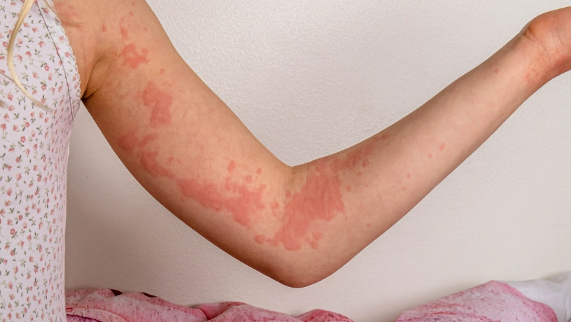 textile dermatitis textile dermatitis